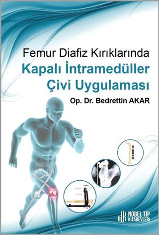 Femur Diafiz Kırıklarında Kapalı İntramedüller Çivi Uygulaması